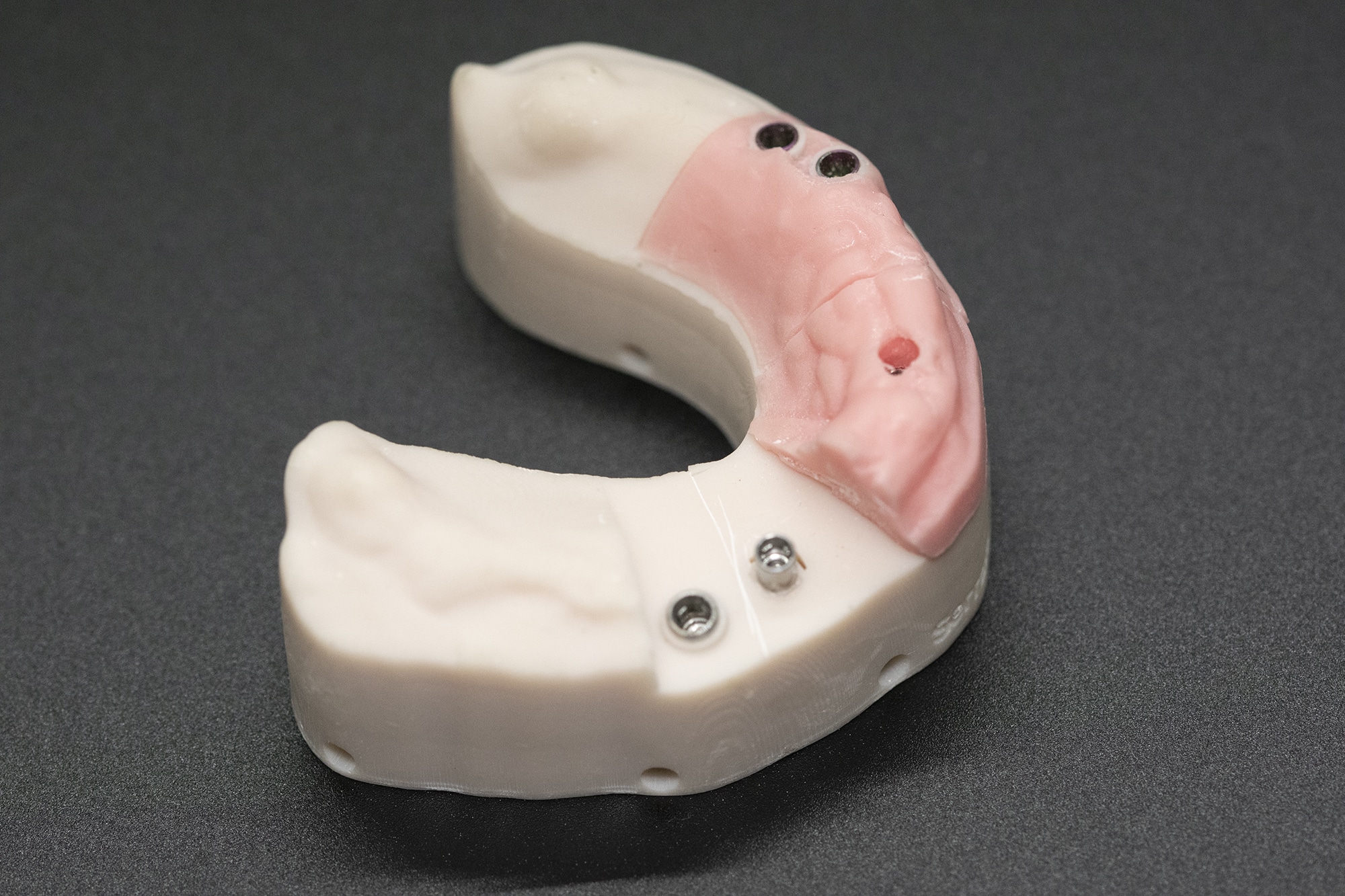 3D-Printed-Implant-Model-with-Soft-Tissue