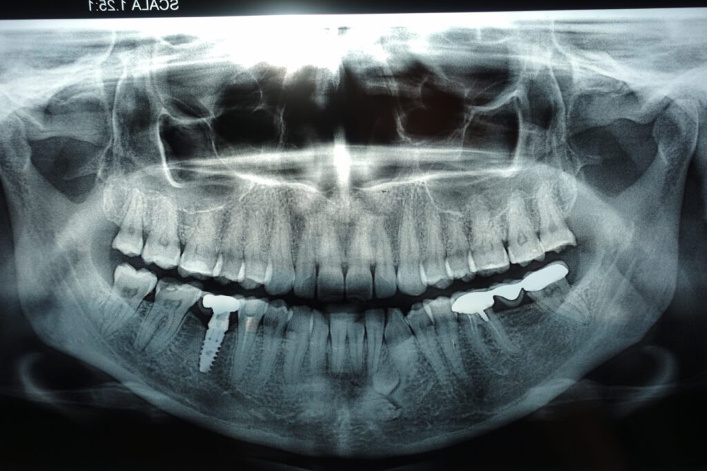 Dental Panoramic Xray