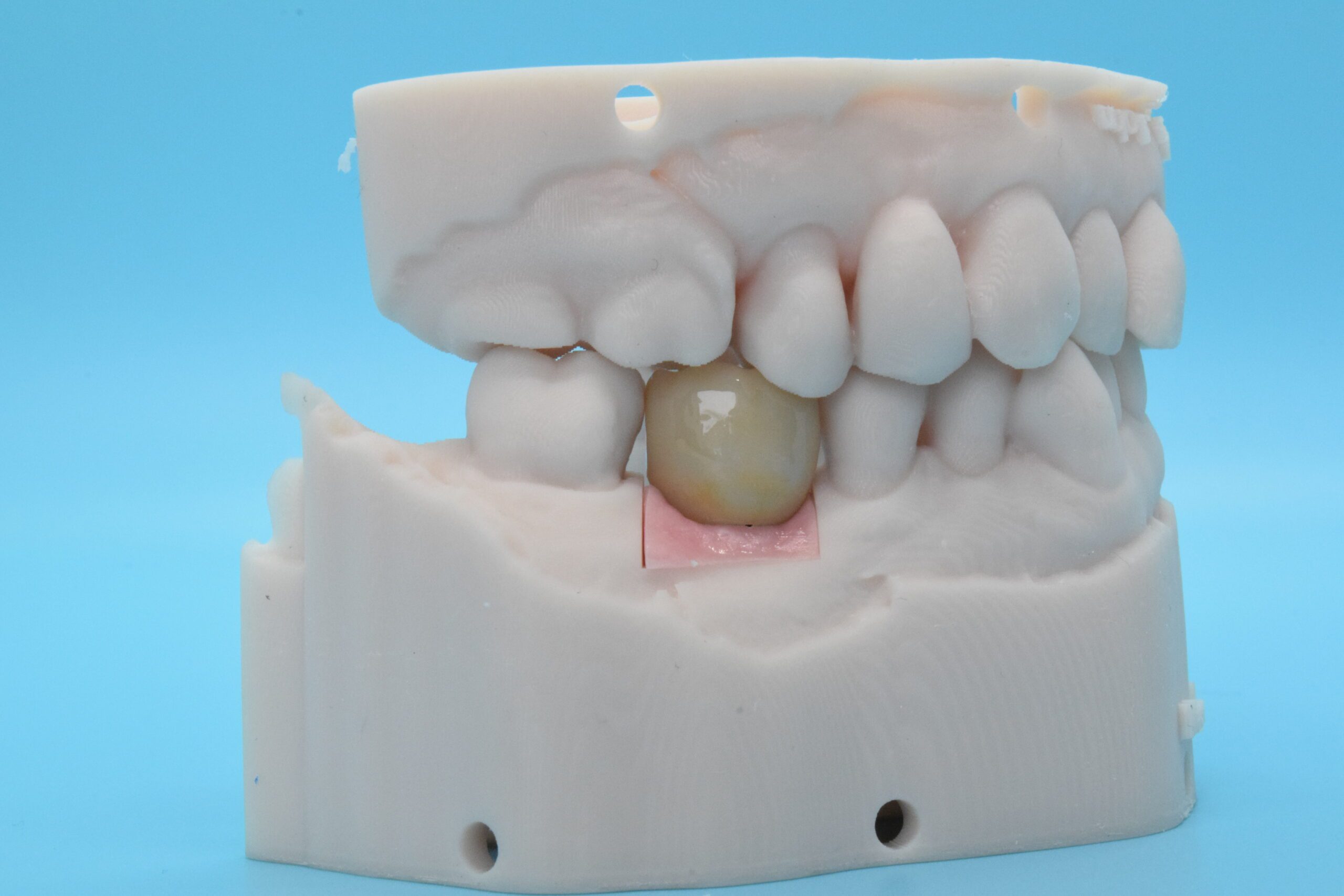 Implant Crown with 3D Printed Model