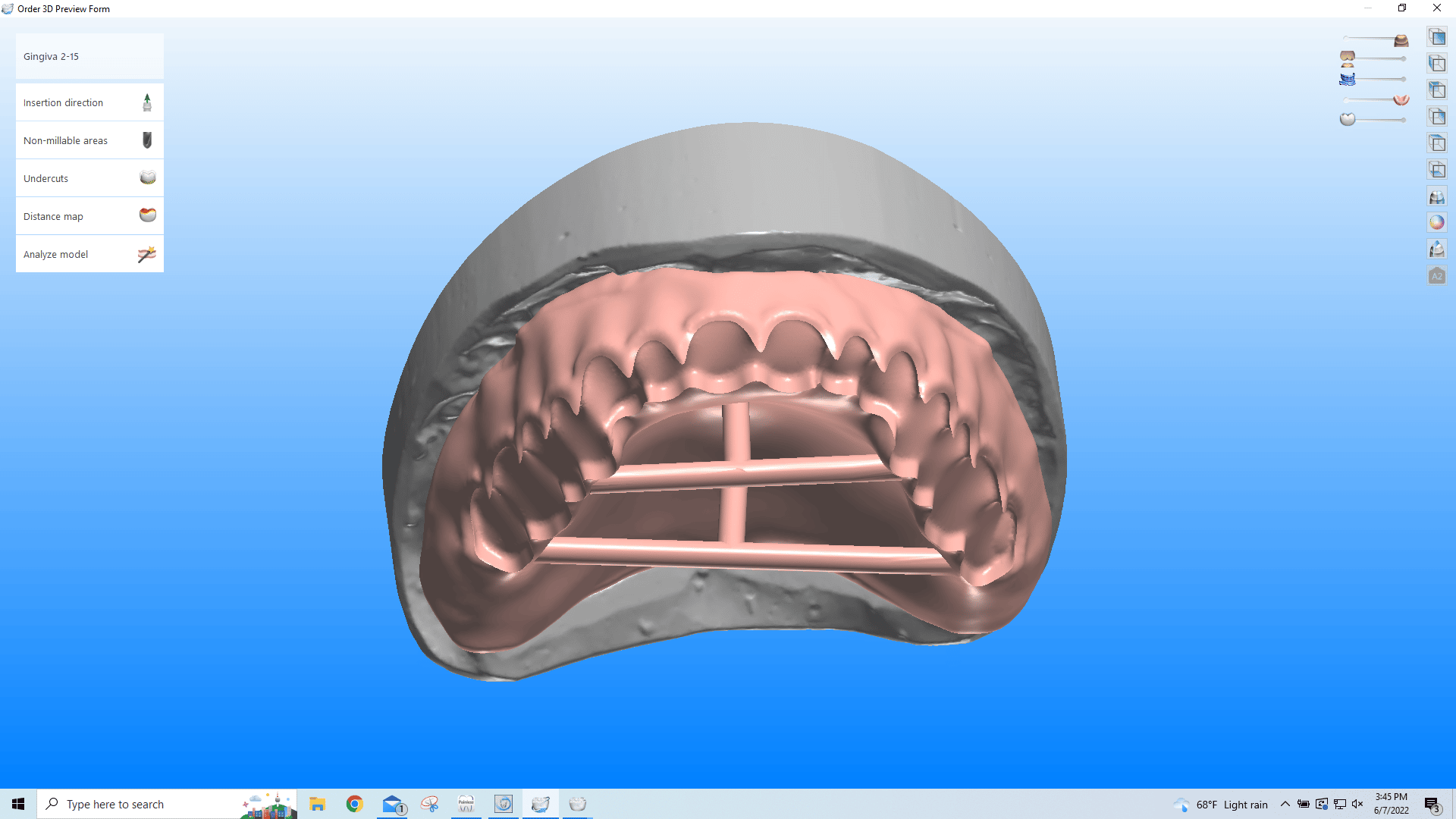 CAD/CAM Digital Denture Design