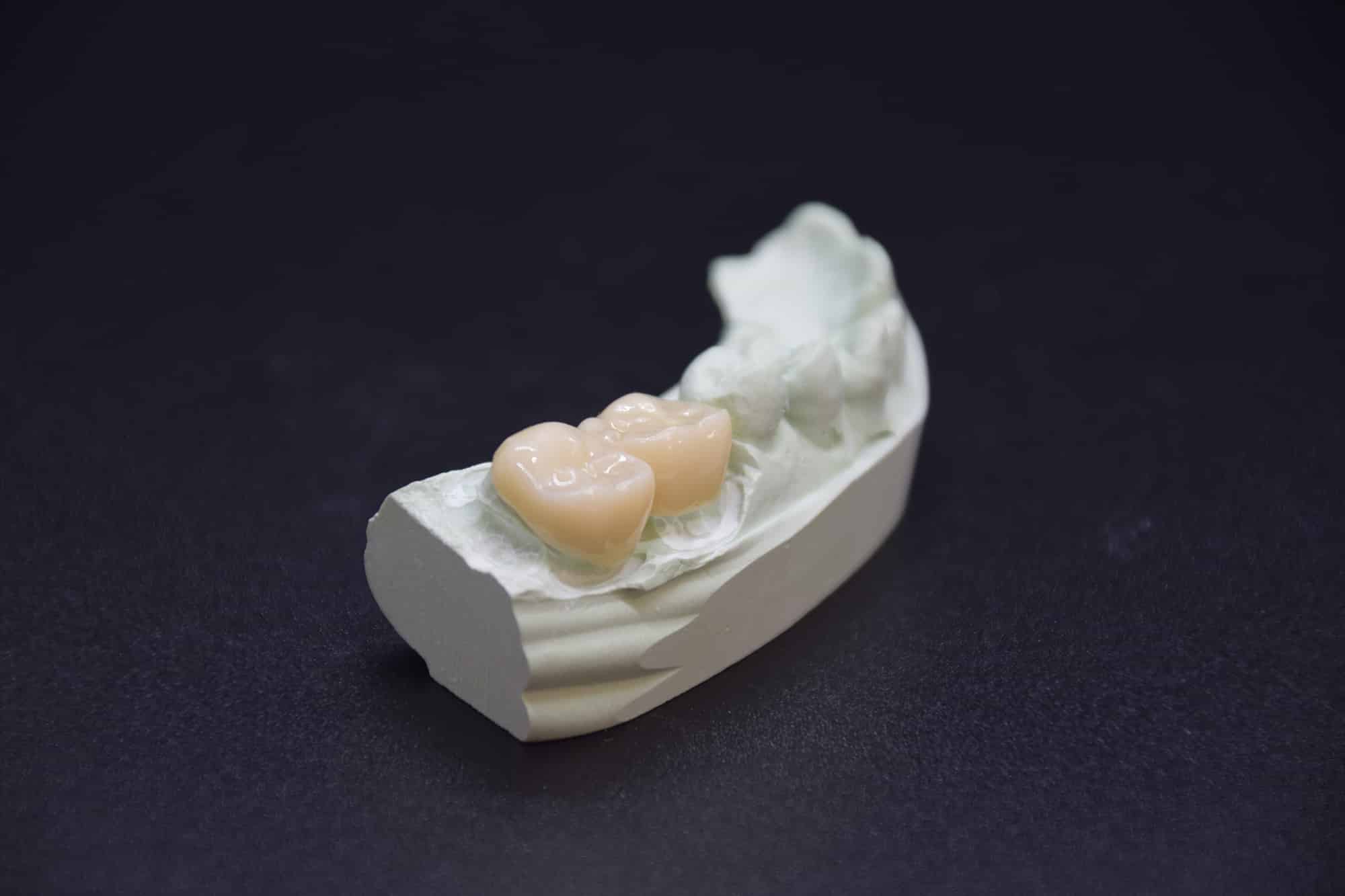 Two single unit zirconia dental crowns