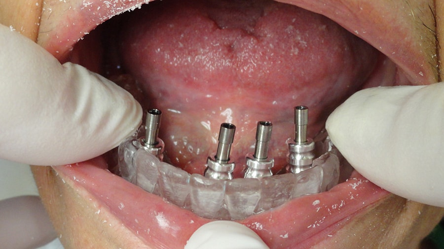 Custom Implant Open Impression Tray