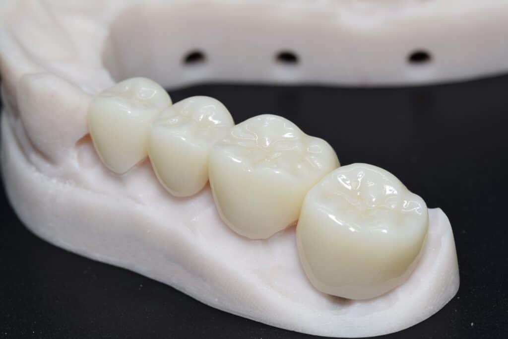 4 Single Unit Zirconia Crowns