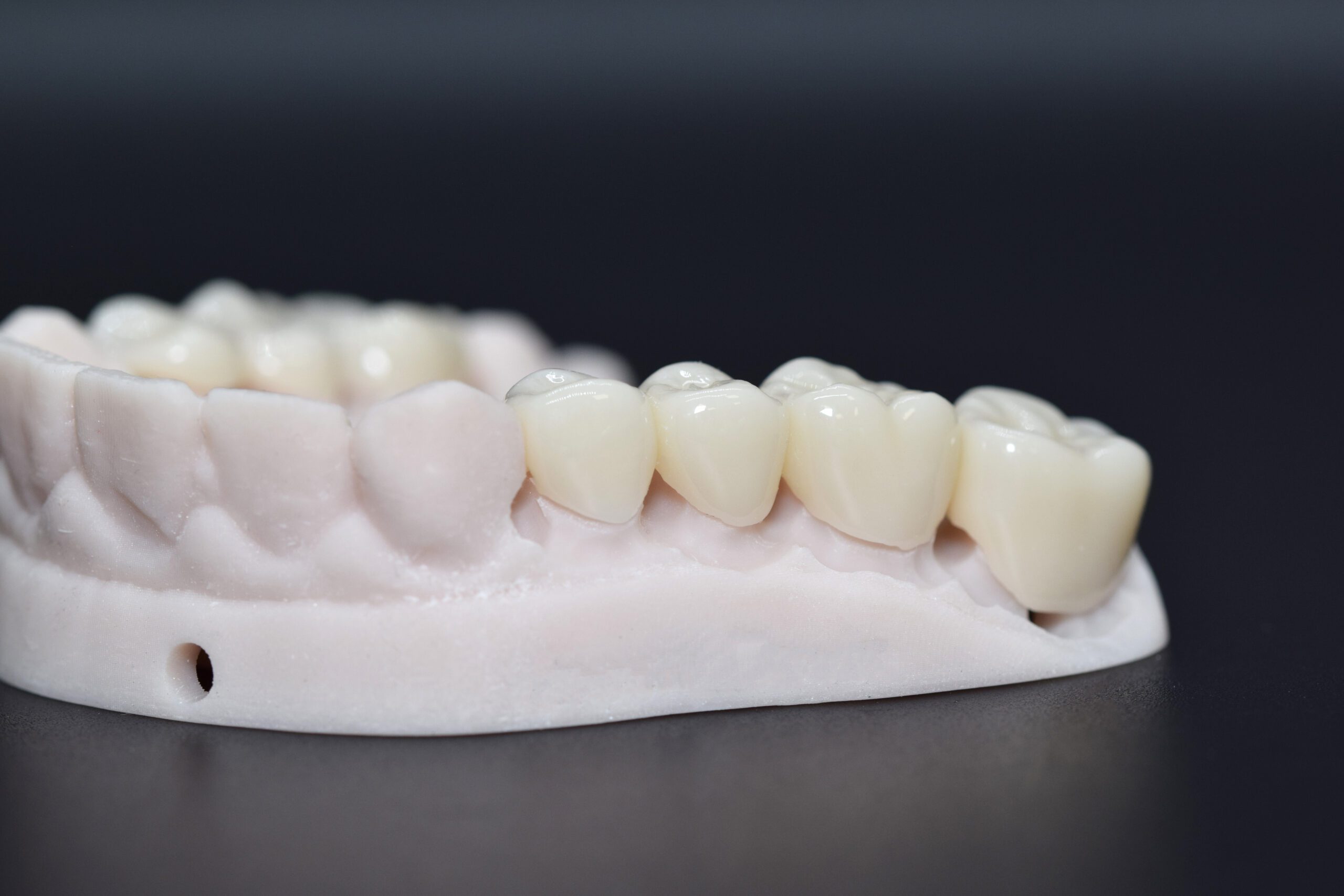 Single Unit Zirconia Crowns on 3D printed models