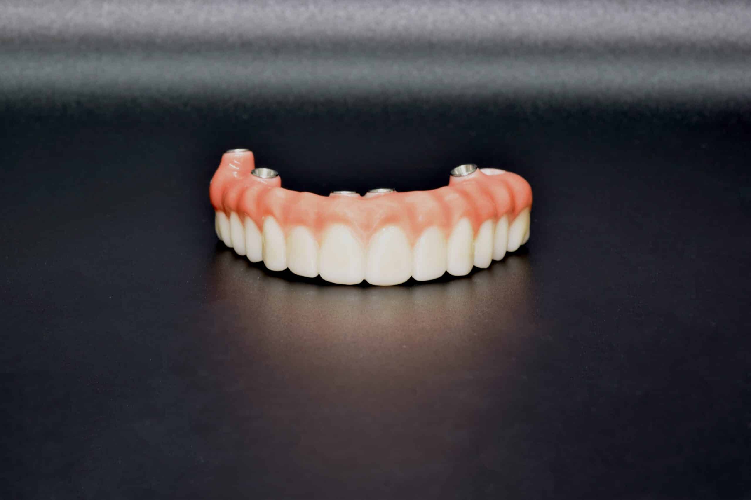 “All on 4” Full Zirconia Arch – Procedure