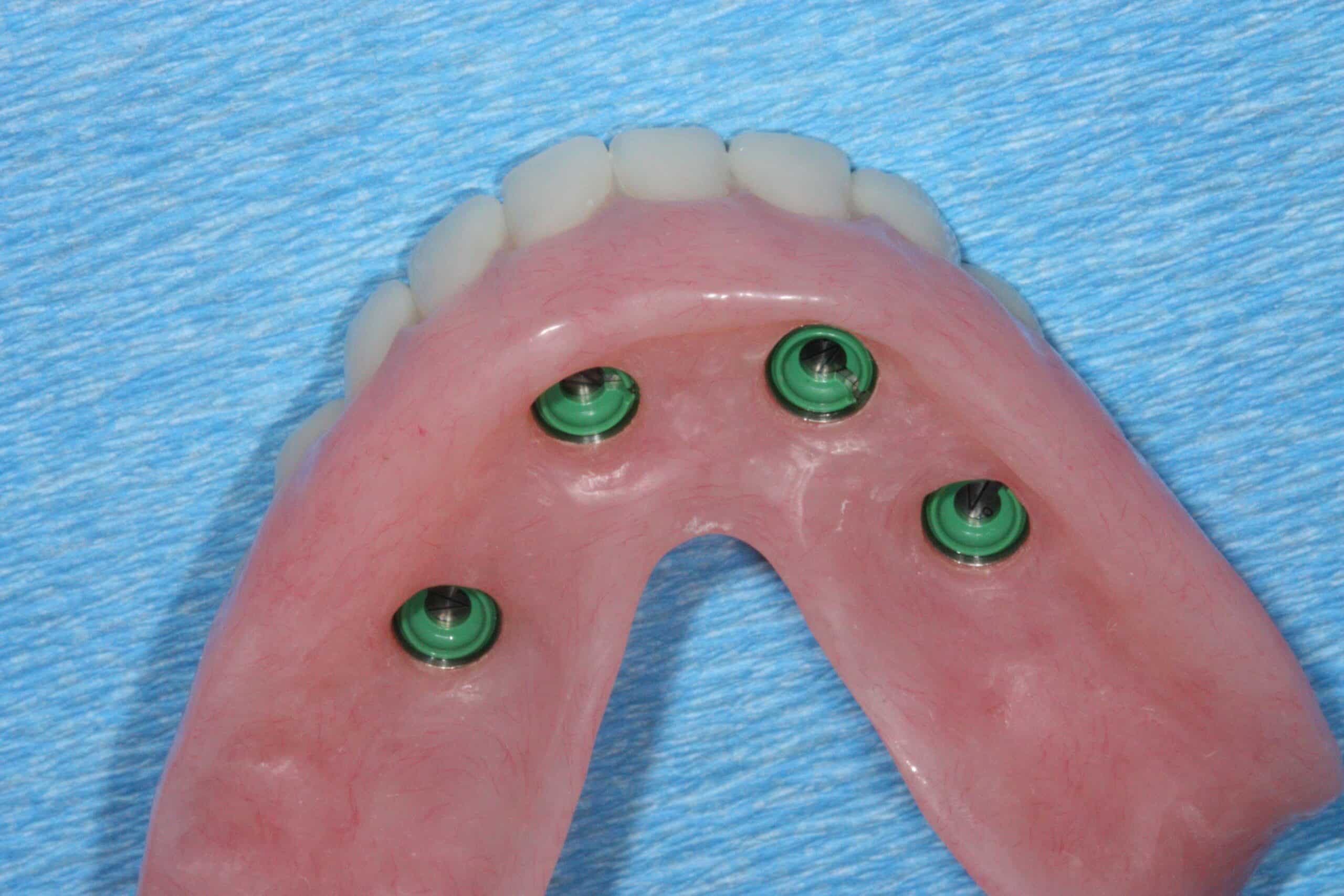 thumbnail image 2 of Implantix Overdenture Abutment Male Caps – Soft Pink Retentive Inserts 3.0 Lbs (10 Pack) 2 of 4
