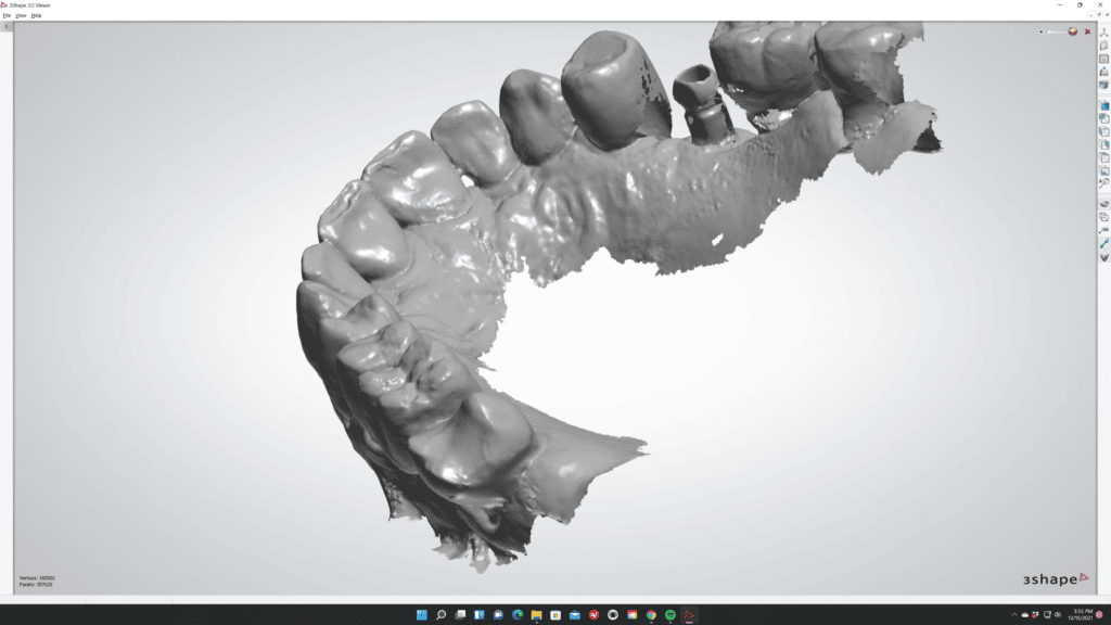 Intraoral Scan - Missing Data