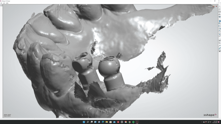 Intraoral Scan of Implant