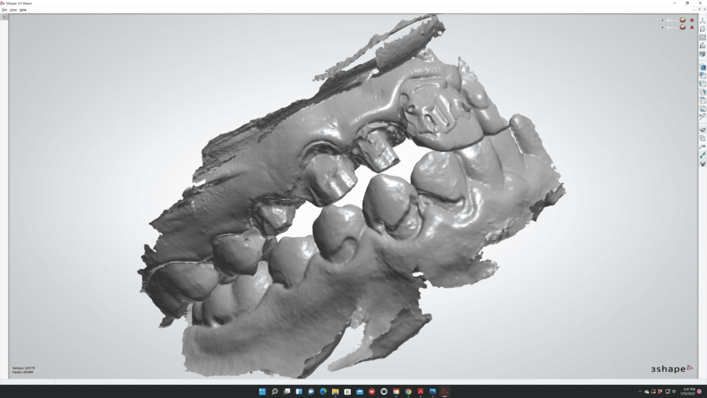 Intraoral Scan - Delineation