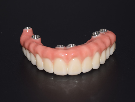 Full Arch Zirconia Implant Prosthesis