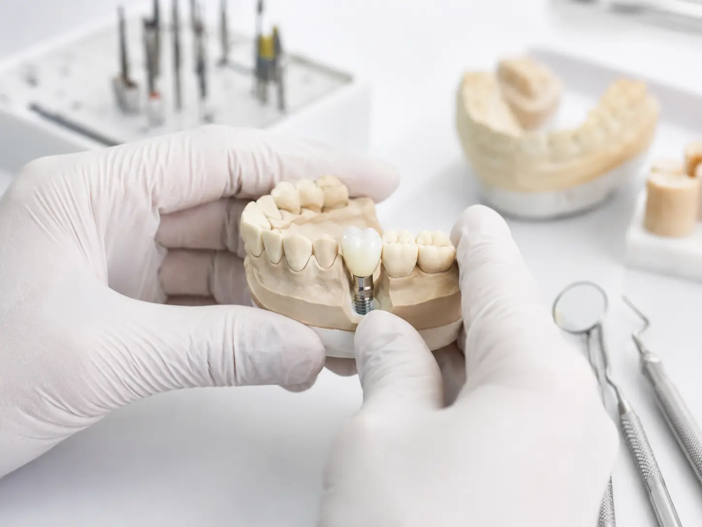 Custom abutments and zirconia restorations